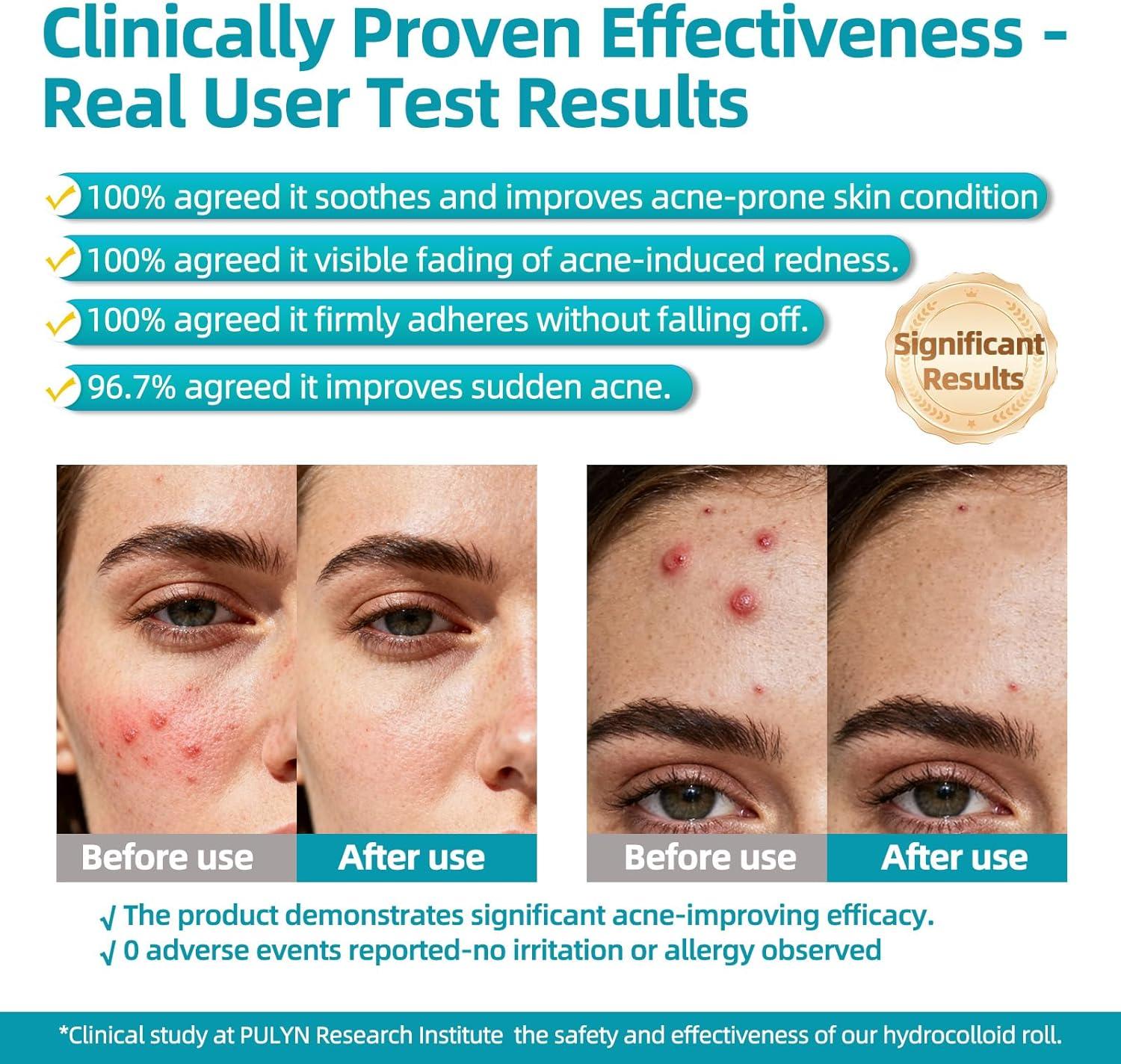 imageDimora Medical Grade Hydrocolloid Roll 2in16ft Highly Absorbent Hydrocolloid Bandages for Wound Care Burn Blister Acne Care Waterproof ampamp Cut to Size