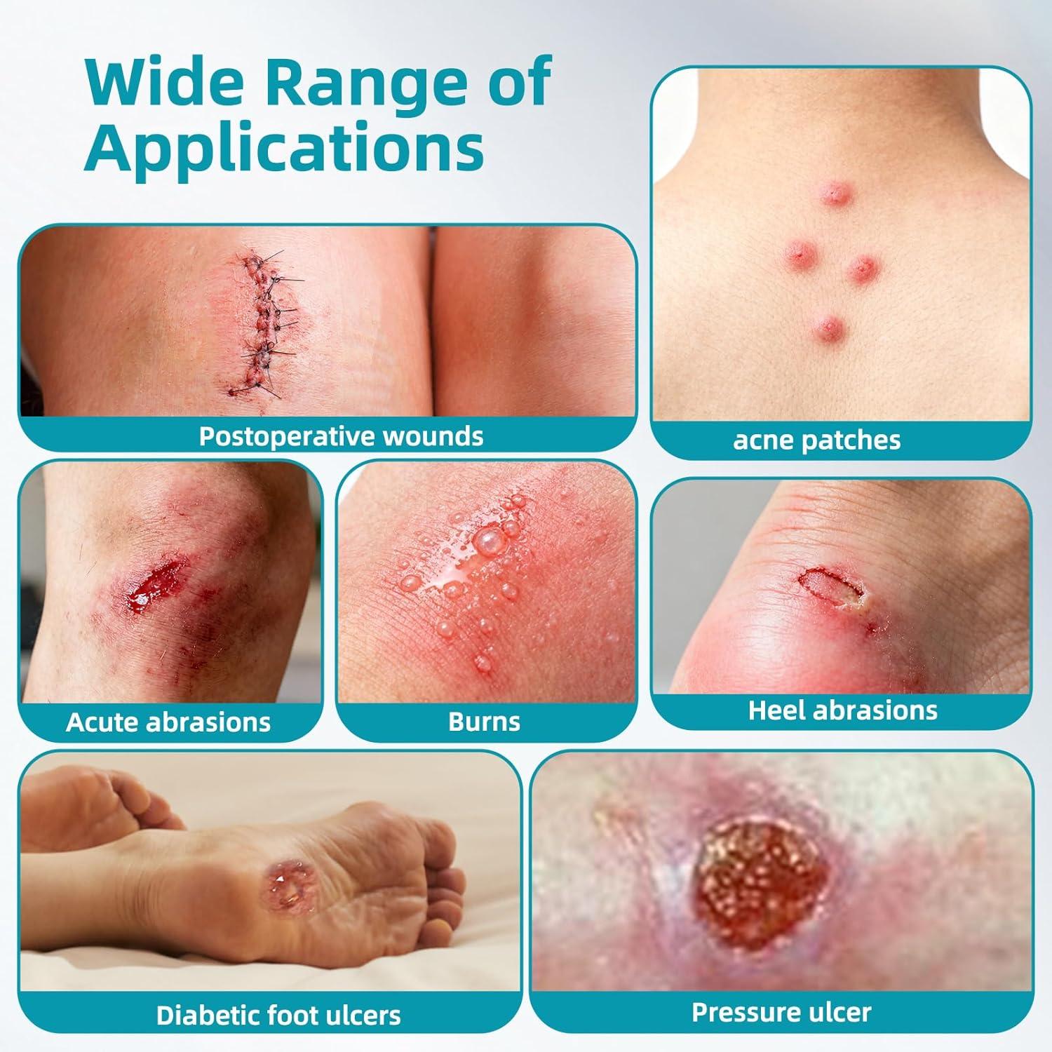 imageDimora Medical Grade Hydrocolloid Roll 2in16ft Highly Absorbent Hydrocolloid Bandages for Wound Care Burn Blister Acne Care Waterproof ampamp Cut to Size