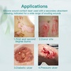 image:imageDimora Calcium Alginate Wound Dressing with Silicone Wound Contact Layer