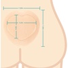 image:imageFill and Protect Wound Cavity Prevent Pressure harm